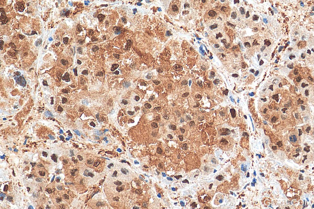 IHC staining of human liver cancer using 80570-1-RR (same clone as 80570-1-PBS)