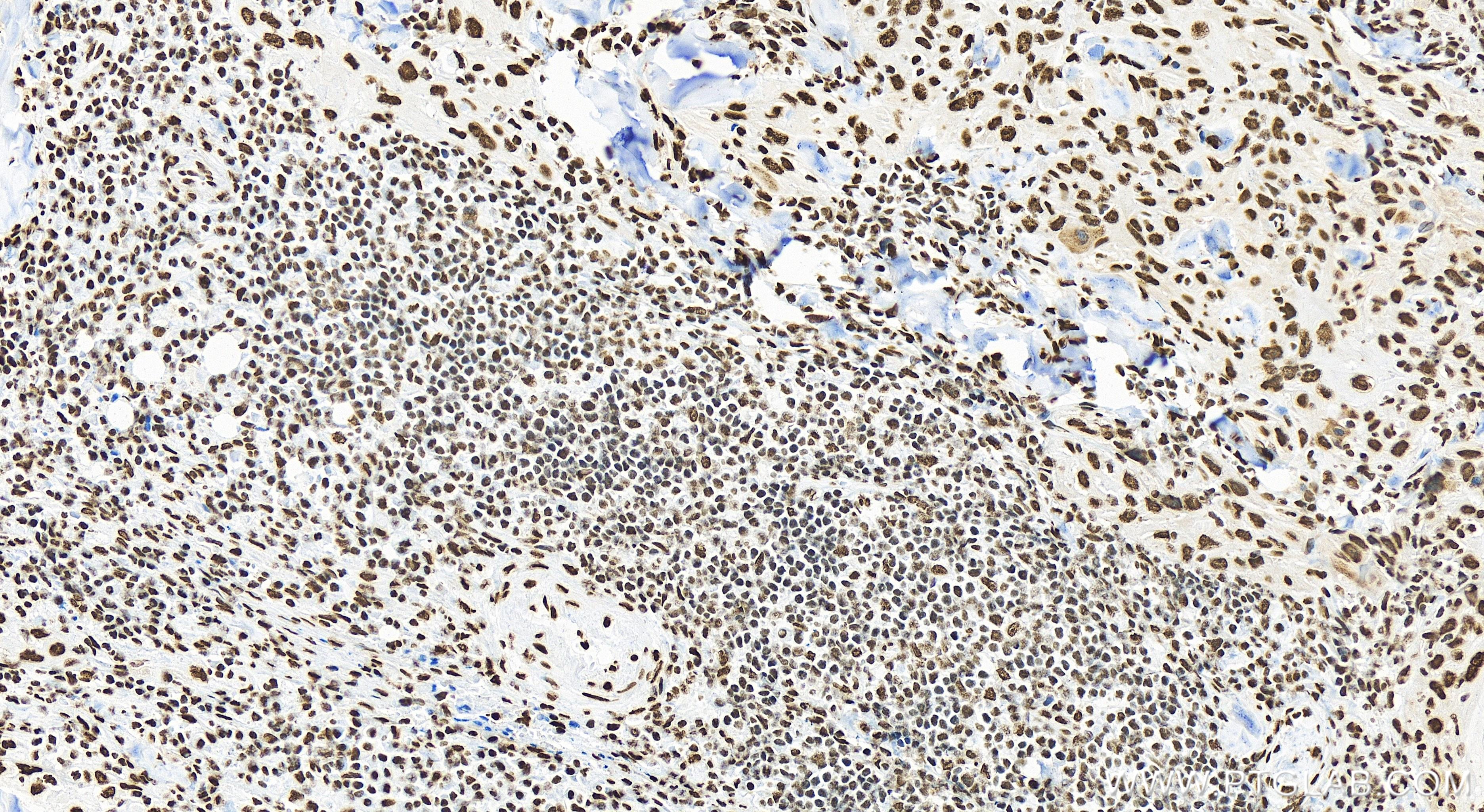 IHC staining of human skin cancer using 83577-1-RR