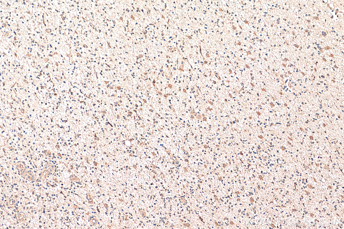 IHC staining of human gliomas using 17903-1-AP