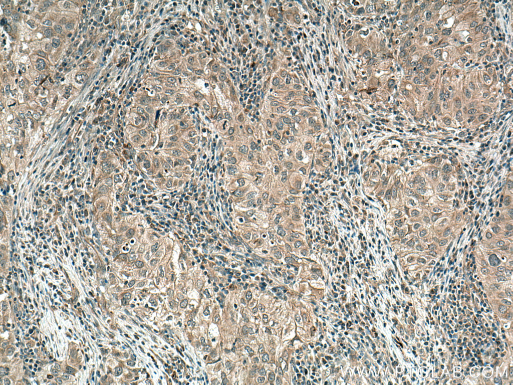 IHC staining of human lung cancer using 13795-1-AP