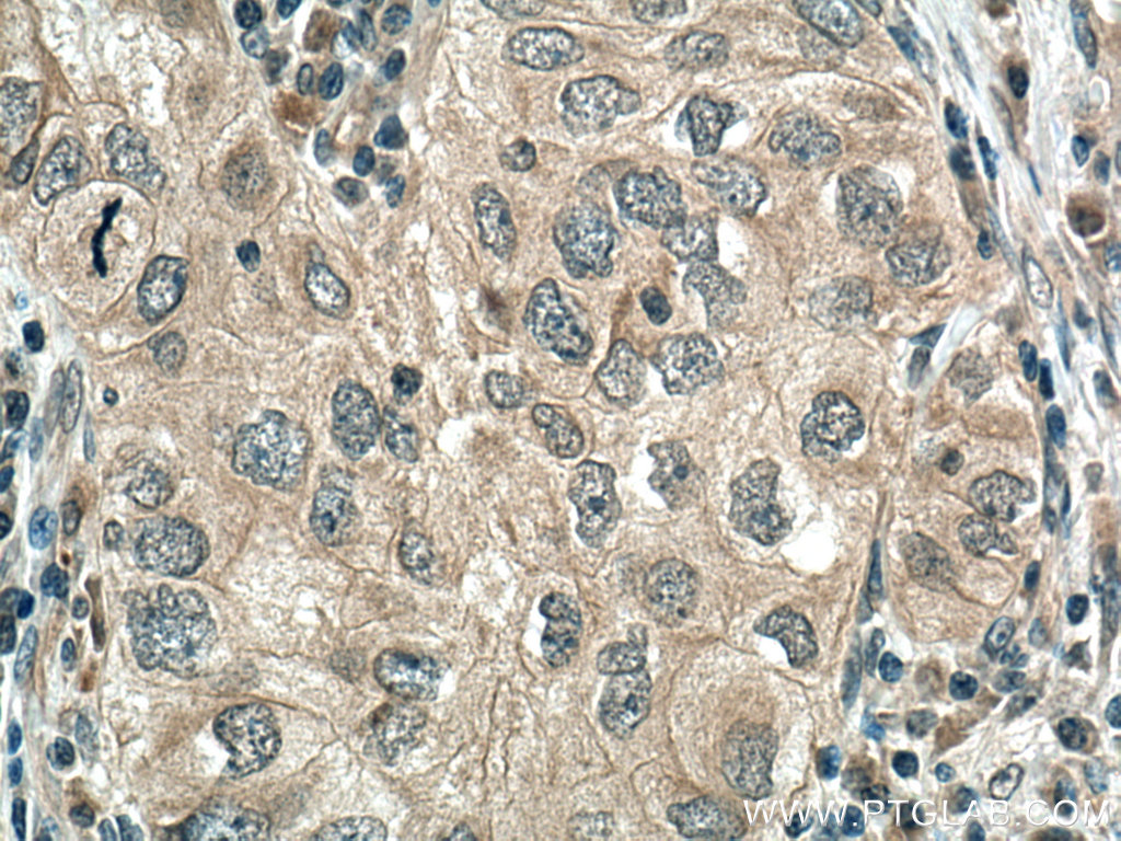 IHC staining of human lung cancer using 13795-1-AP