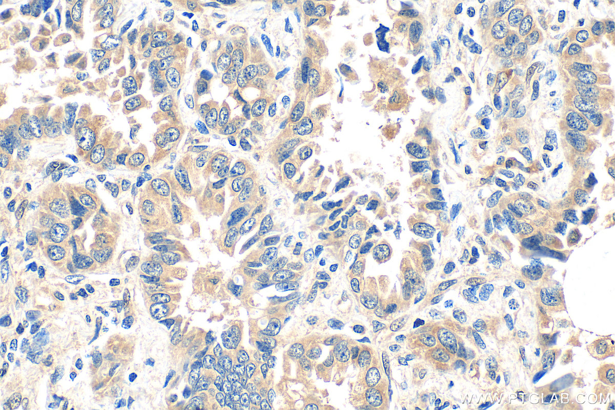 IHC staining of human lung cancer using 13795-1-AP