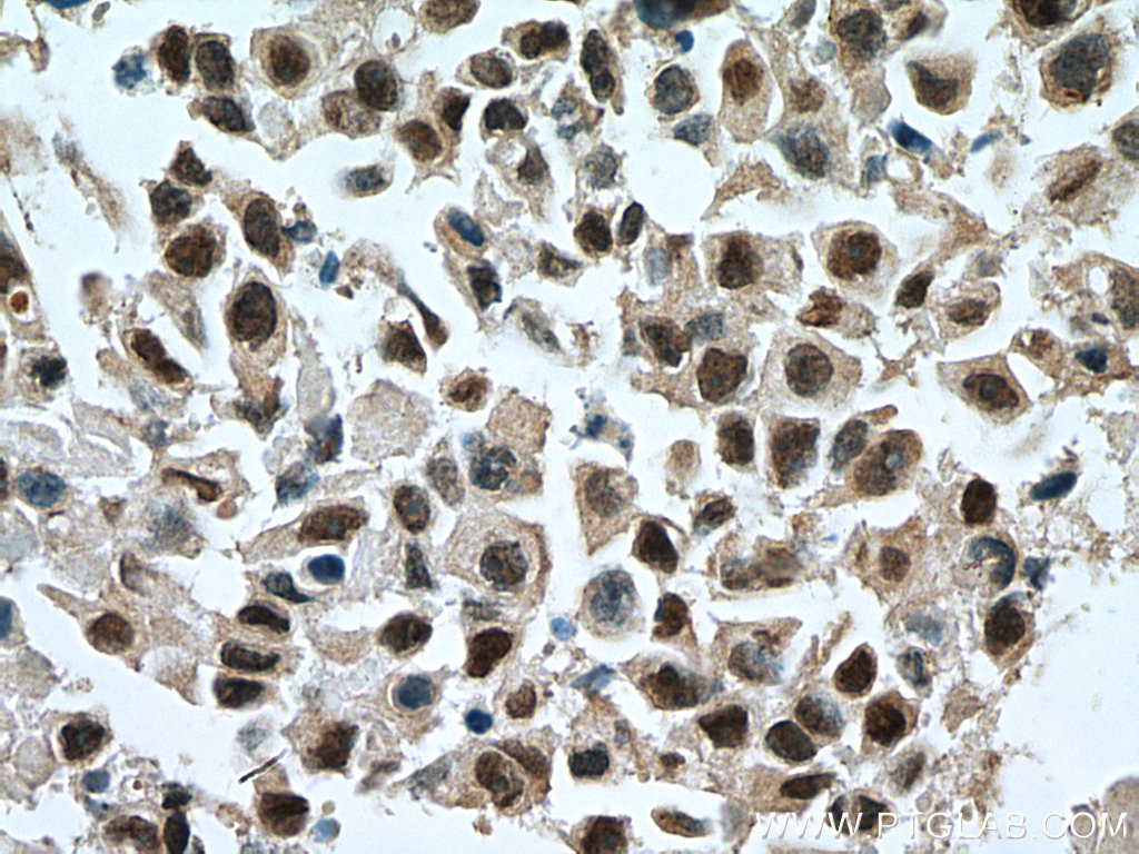 IHC staining of human breast cancer using 10417-1-AP