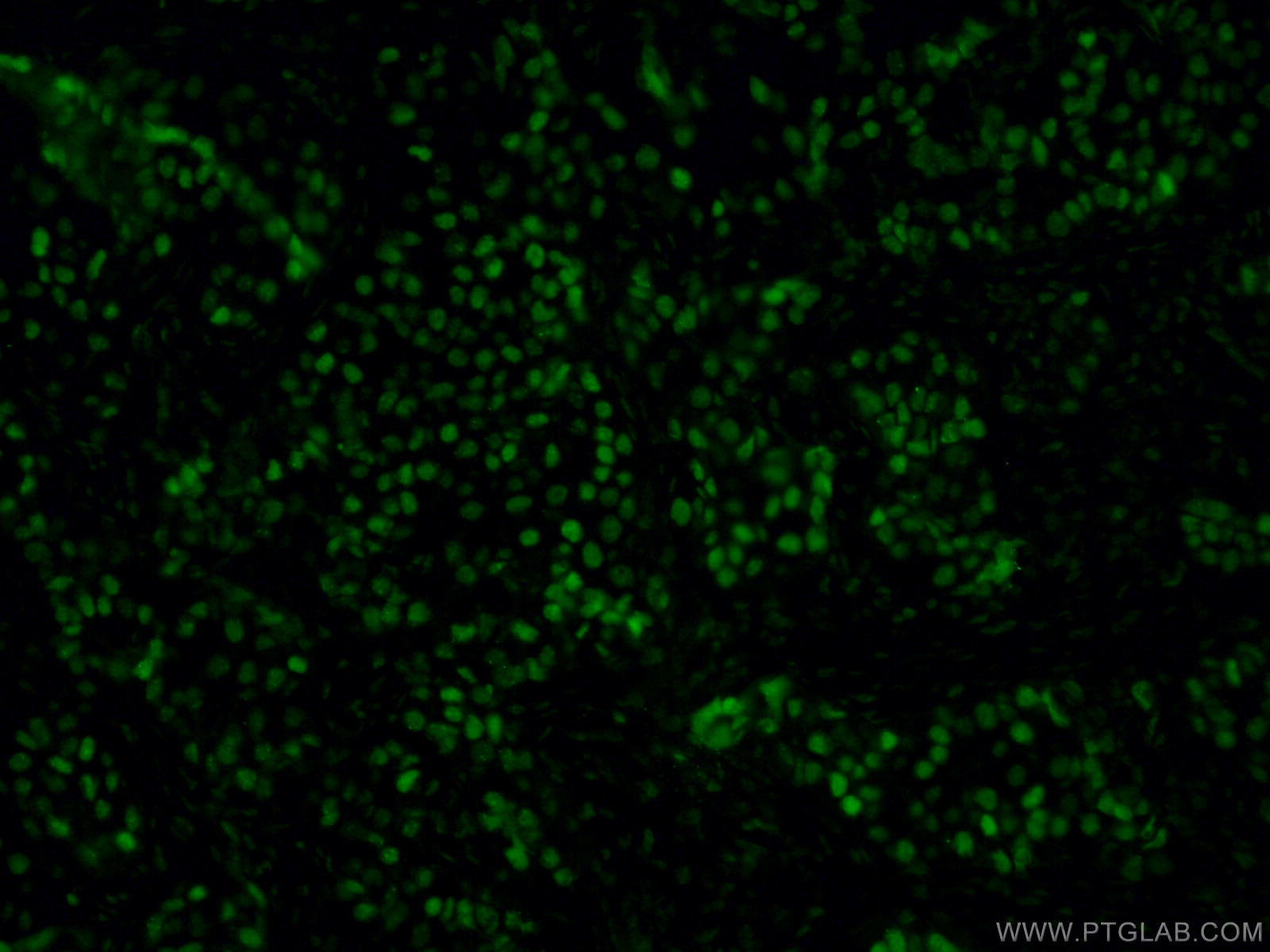 IF Staining of human breast cancer using 66400-1-Ig