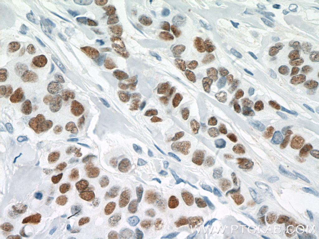 IHC staining of human breast cancer using 66400-1-Ig (same clone as 66400-1-PBS)