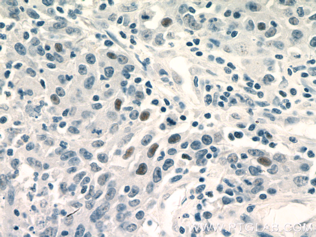 IHC staining of human colon cancer using 66400-1-Ig (same clone as 66400-1-PBS)