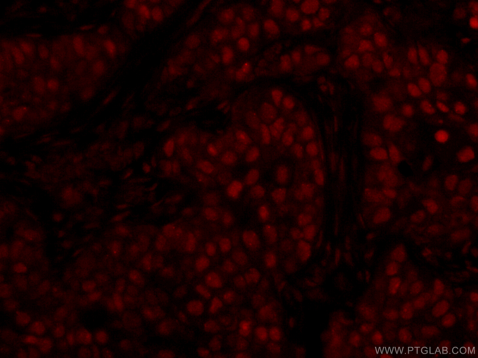 IF Staining of human breast cancer using CL594-66400