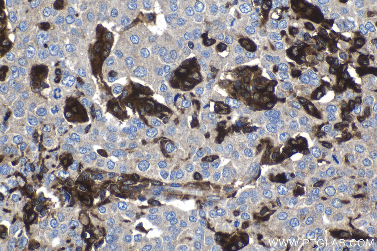 IHC staining of human ovary tumor using 13220-1-AP IHC staining of human ovary tumor using 13220-1-AP