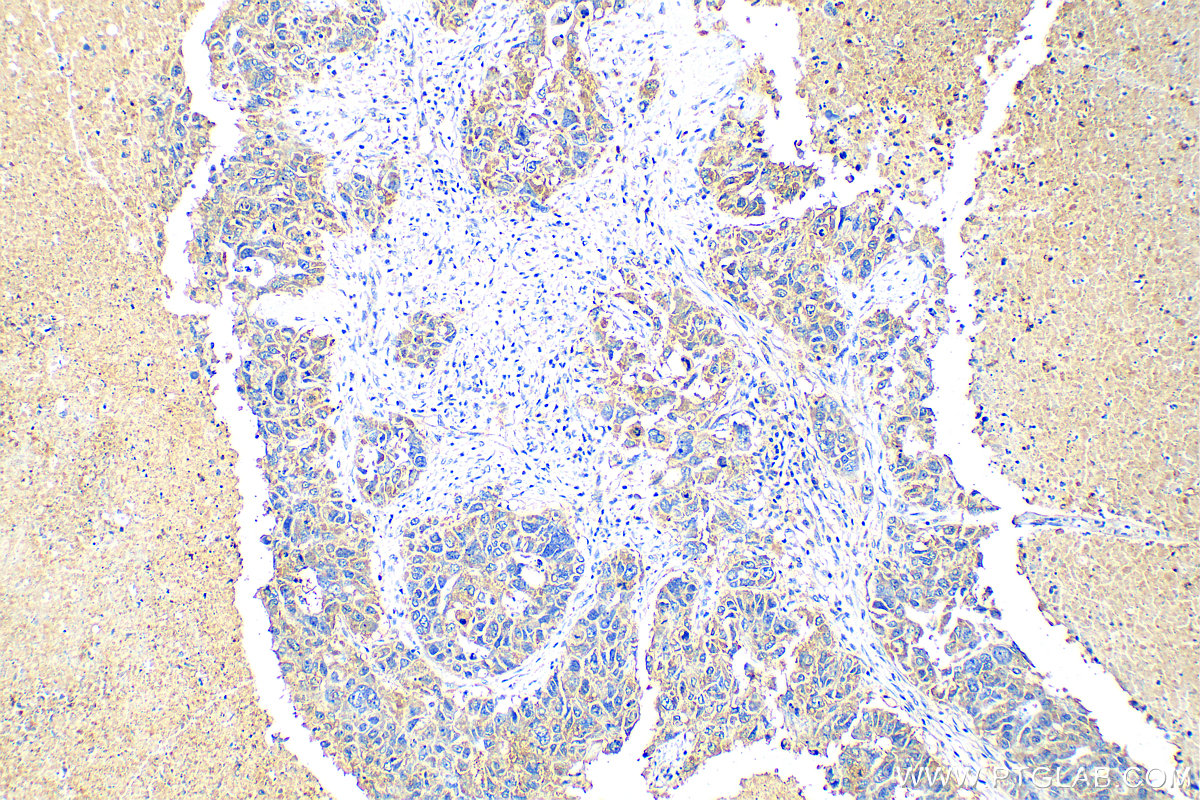 IHC staining of human ovary cancer using 55035-1-AP