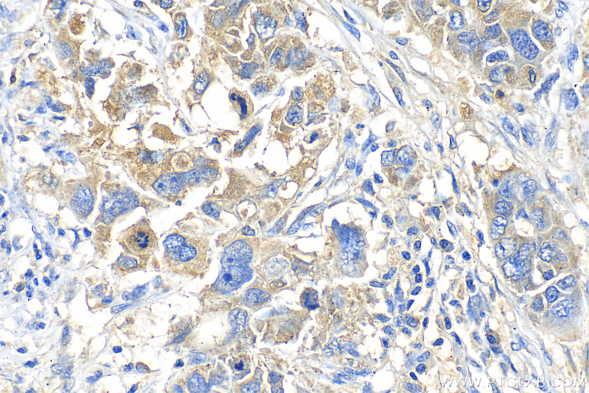 IHC staining of human ovary cancer using 55035-1-AP