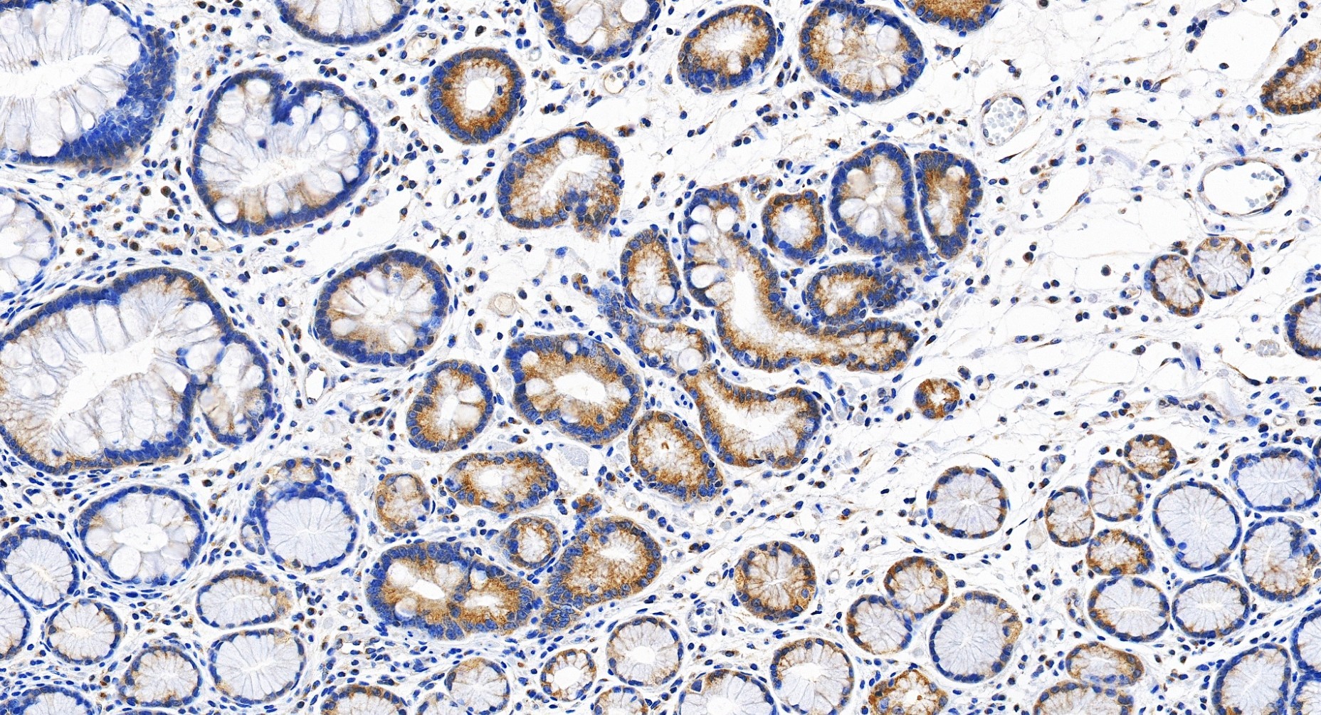 IHC staining of human stomach cancer using 32217-1-AP