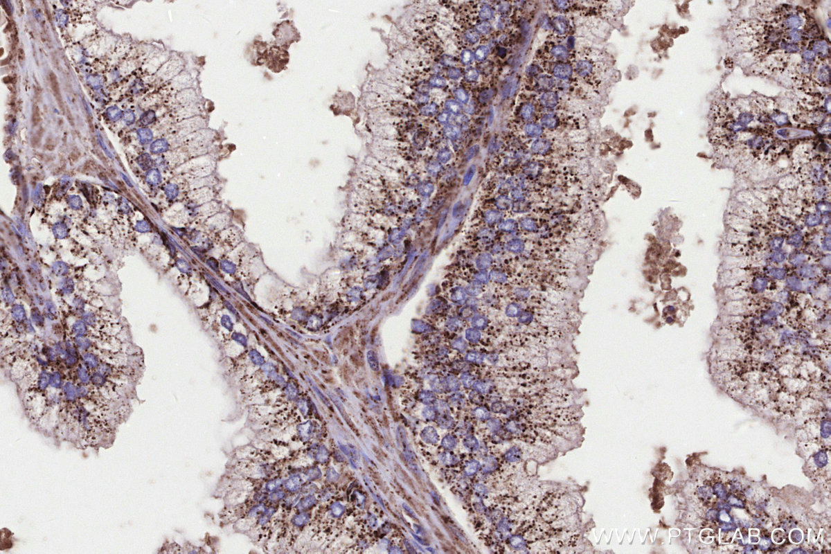 IHC staining of human prostate cancer using 14930-1-AP IHC staining of human prostate cancer using 14930-1-AP