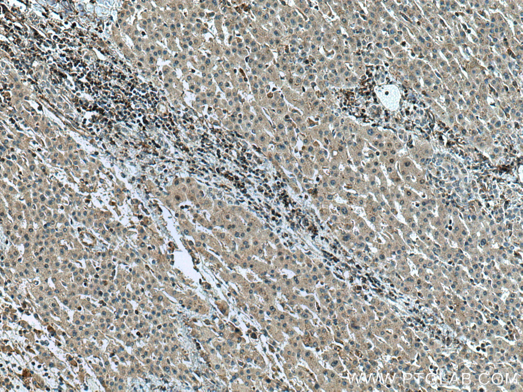 IHC staining of human liver cancer using 15629-1-AP