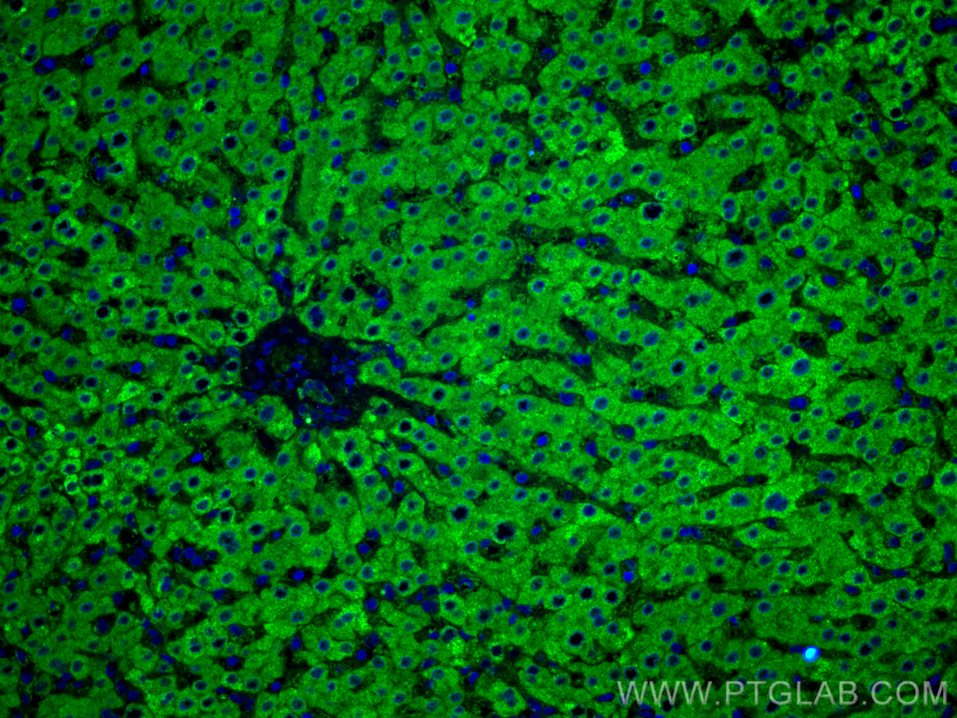 IF Staining of human liver cancer using 67216-1-Ig (same clone as 67216-1-PBS)