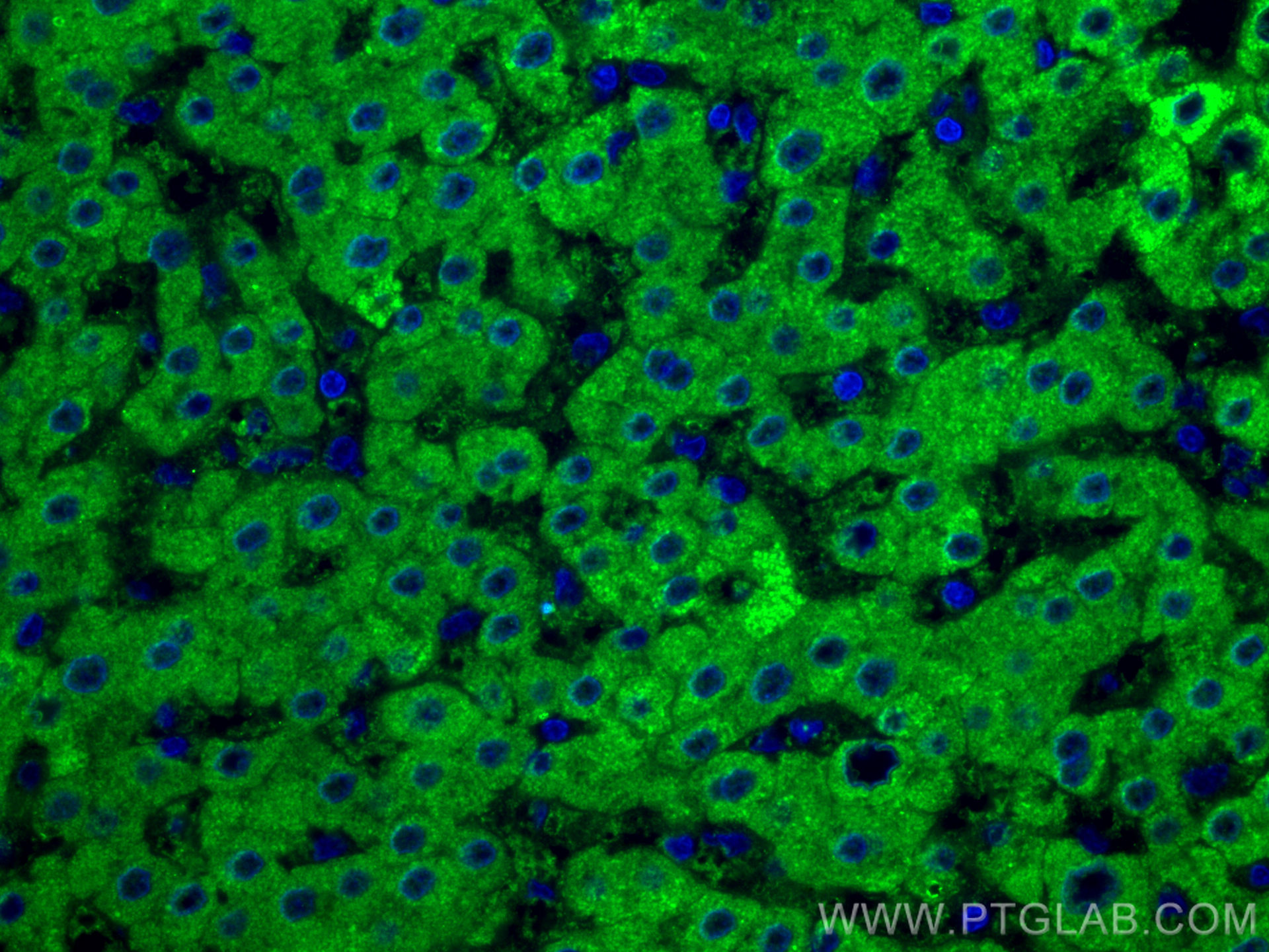 IF Staining of human liver cancer using 67216-1-Ig (same clone as 67216-1-PBS)
