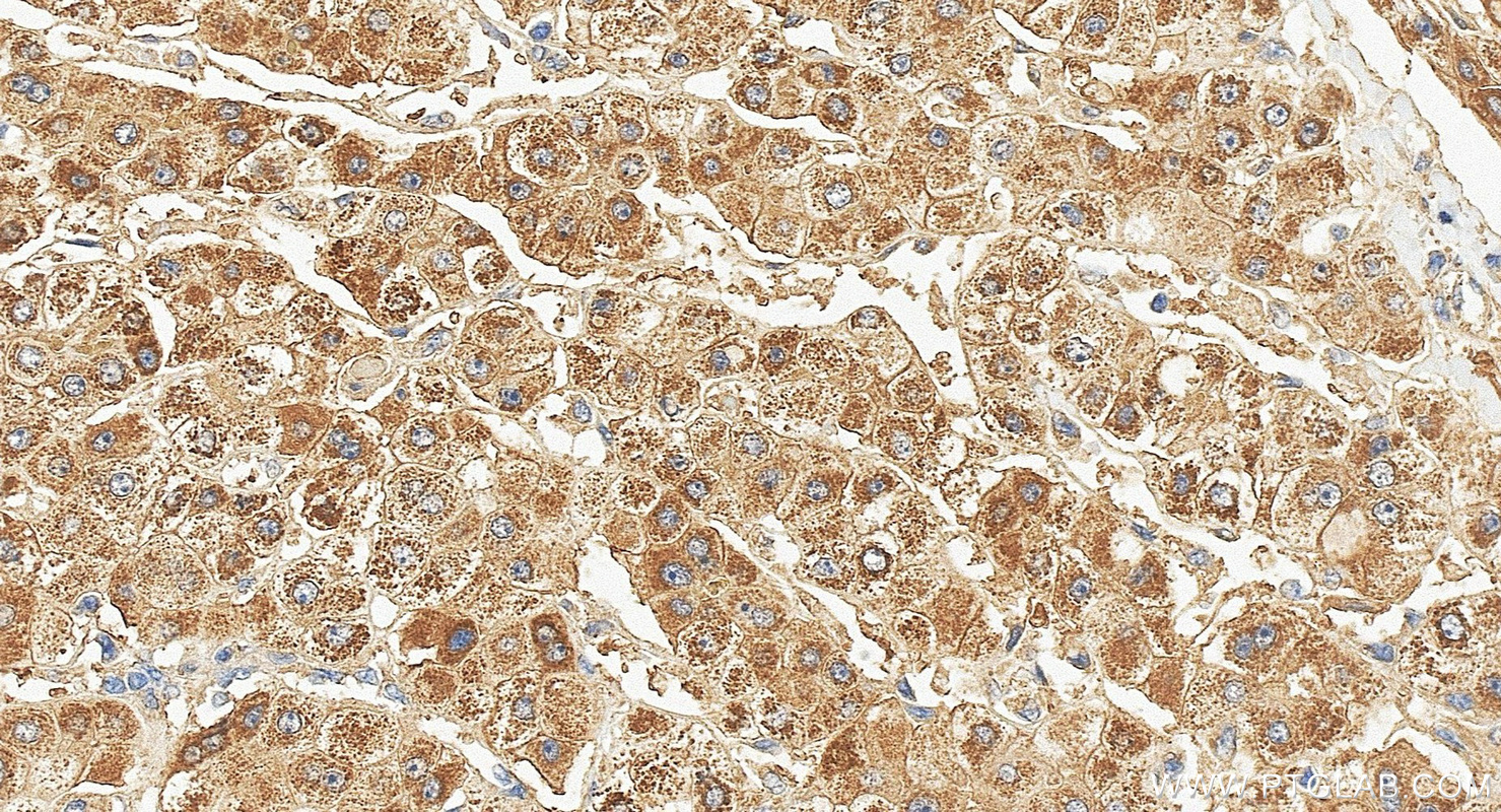 IHC staining of human liver cancer using 67216-1-Ig IHC staining of human liver cancer using 67216-1-Ig
