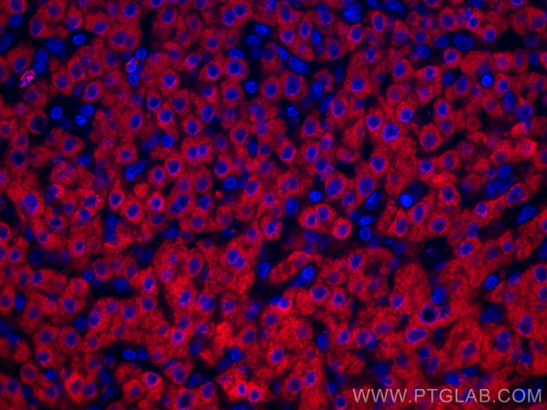 IF Staining of human liver cancer using CL594-67216