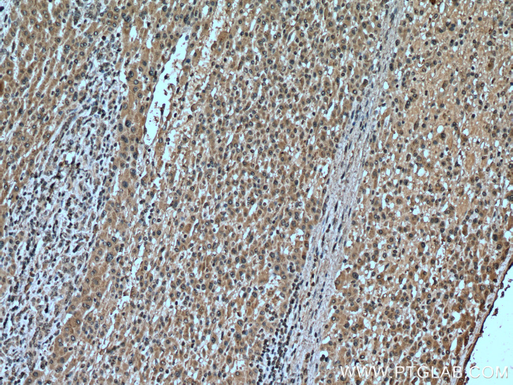 IHC staining of human liver cancer using 66808-1-Ig