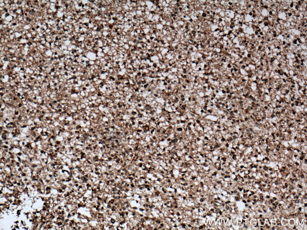 IHC staining of human gliomas using 11977-1-AP