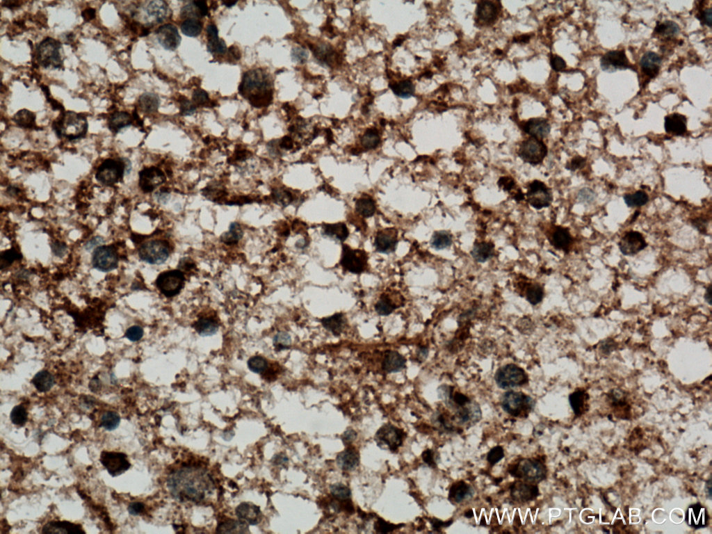 IHC staining of human gliomas using 11977-1-AP