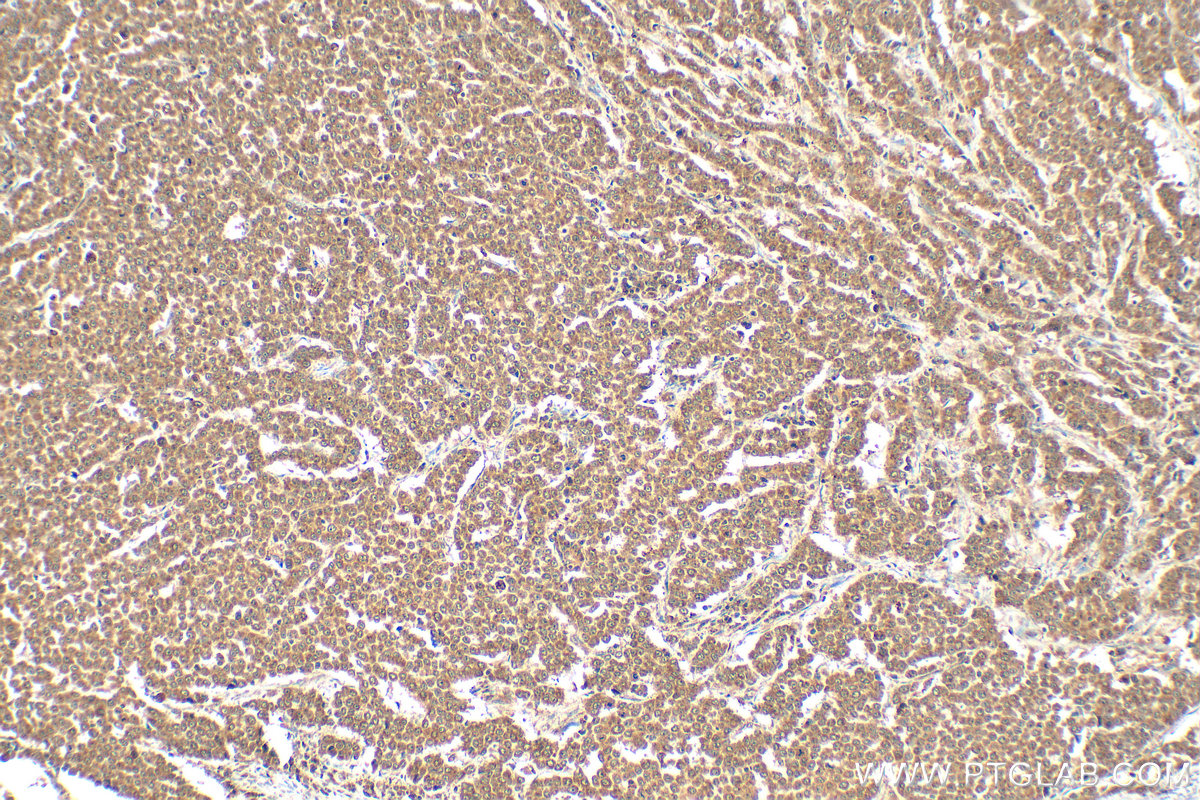 IHC staining of human colon cancer using 26715-1-AP