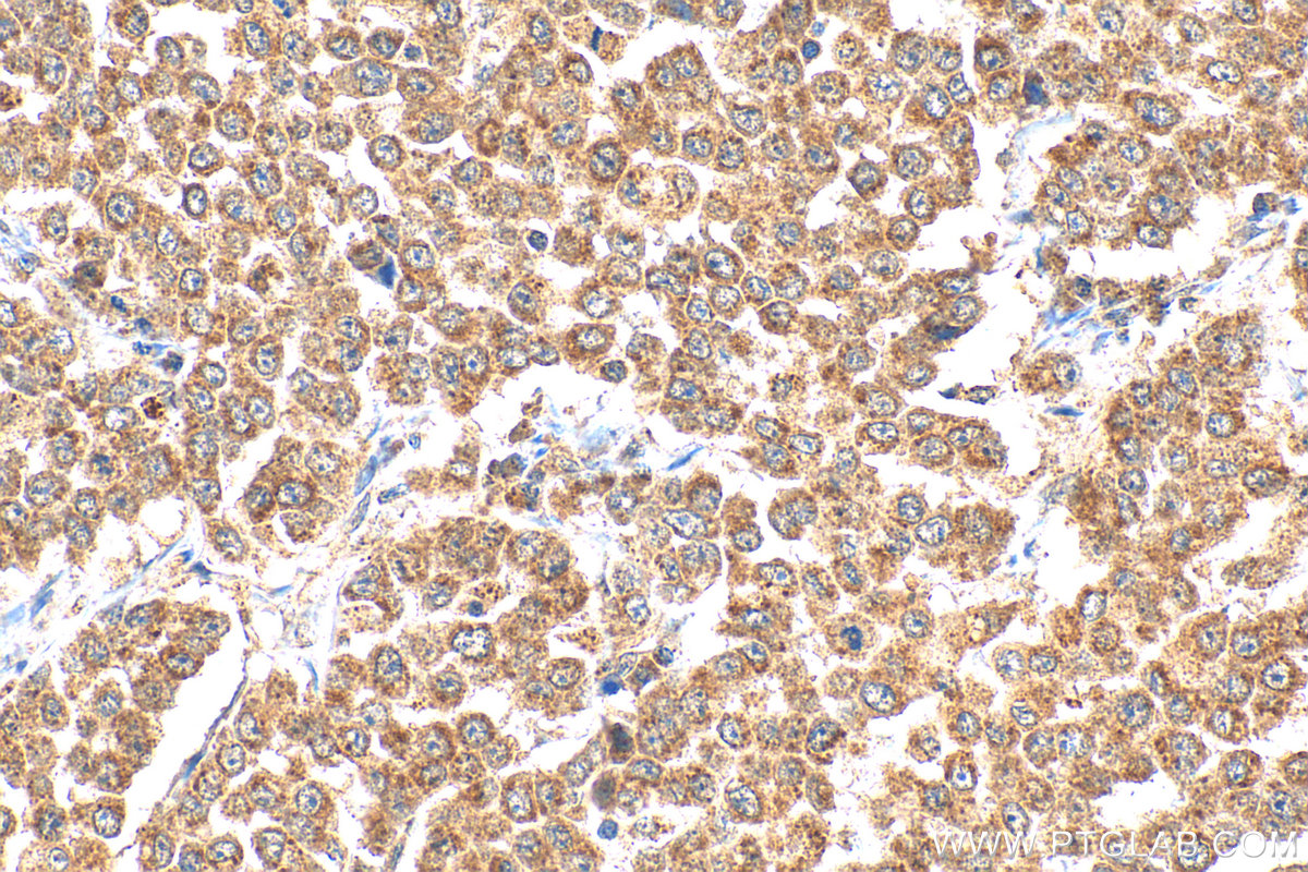 IHC staining of human colon cancer using 26715-1-AP