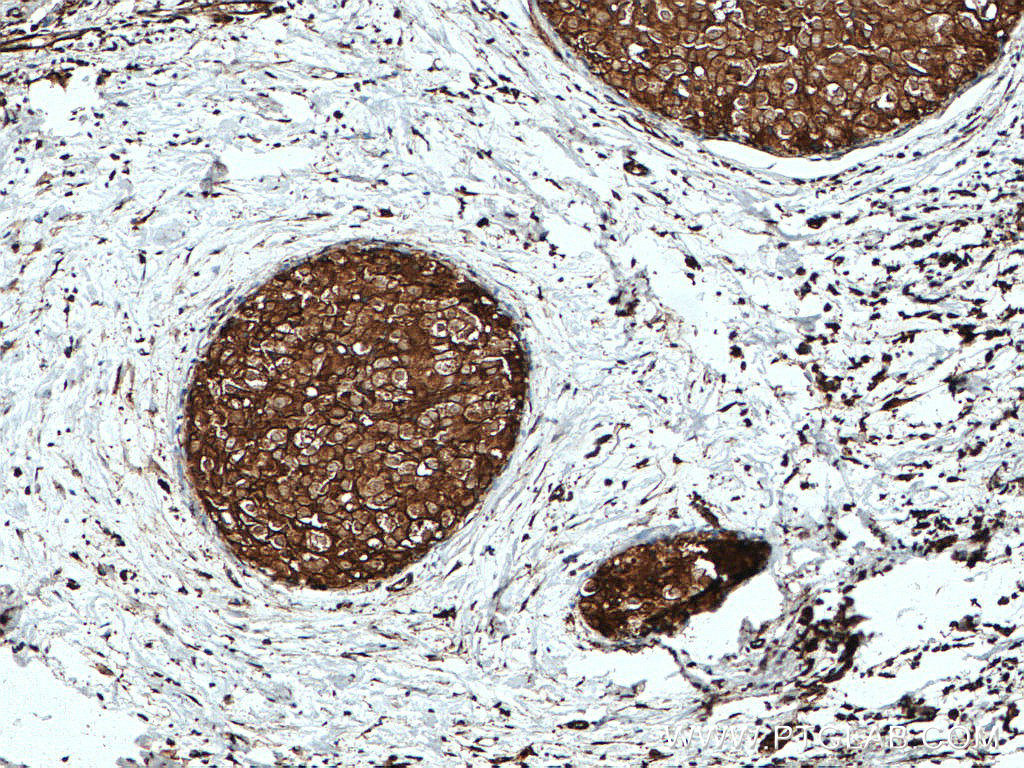 IHC staining of human breast cancer using 10249-1-AP