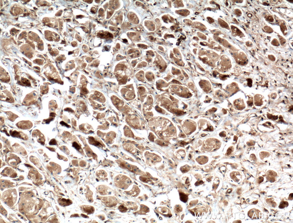 IHC staining of human breast cancer using 66434-1-Ig