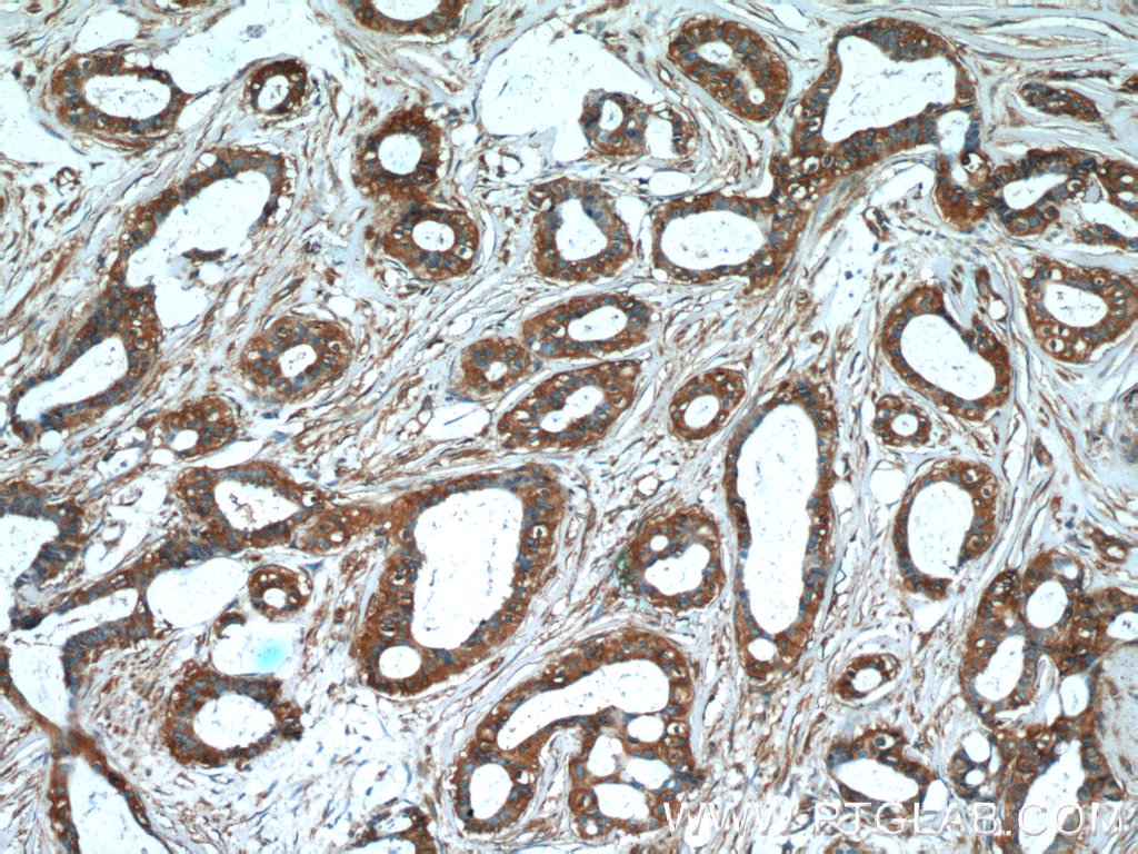 IHC staining of human breast cancer using 60078-1-Ig