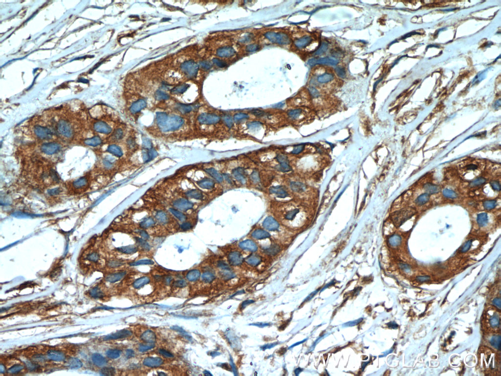 IHC staining of human breast cancer using 60078-1-Ig (same clone as 60078-1-PBS)