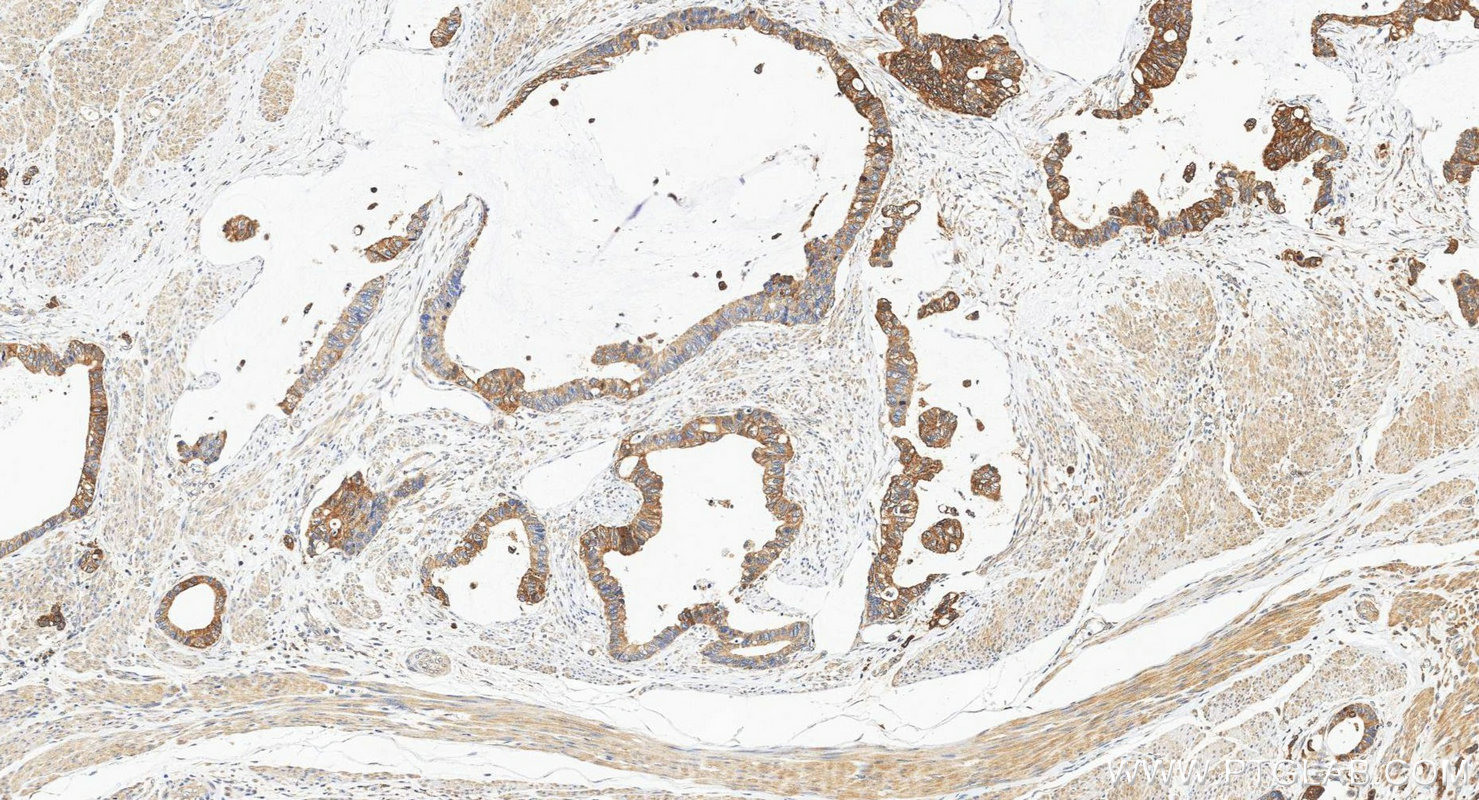IHC staining of human urothelial carcinoma using 20390-1-AP IHC staining of human urothelial carcinoma using 20390-1-AP