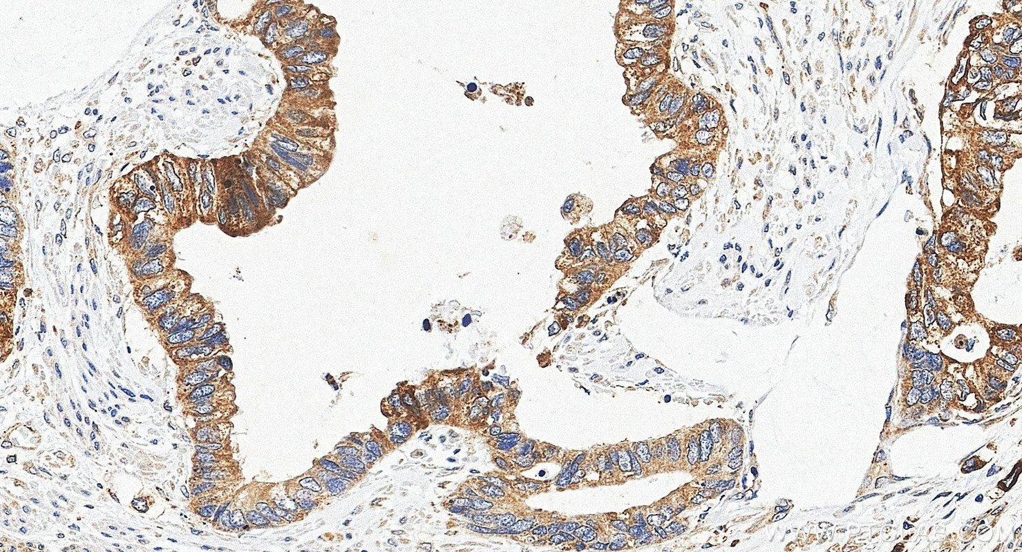 IHC staining of human urothelial carcinoma using 20390-1-AP IHC staining of human urothelial carcinoma using 20390-1-AP