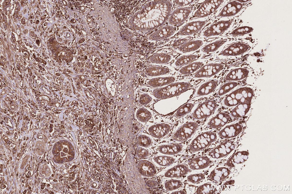IHC staining of human rectal cancer using 24472-1-AP IHC staining of human rectal cancer using 24472-1-AP