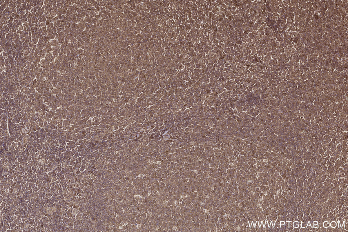 IHC staining of human tonsillitis using 84171-5-RR IHC staining of human tonsillitis using 84171-5-RR