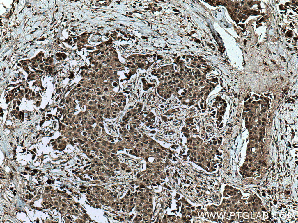 IHC staining of human breast cancer using 12307-2-AP