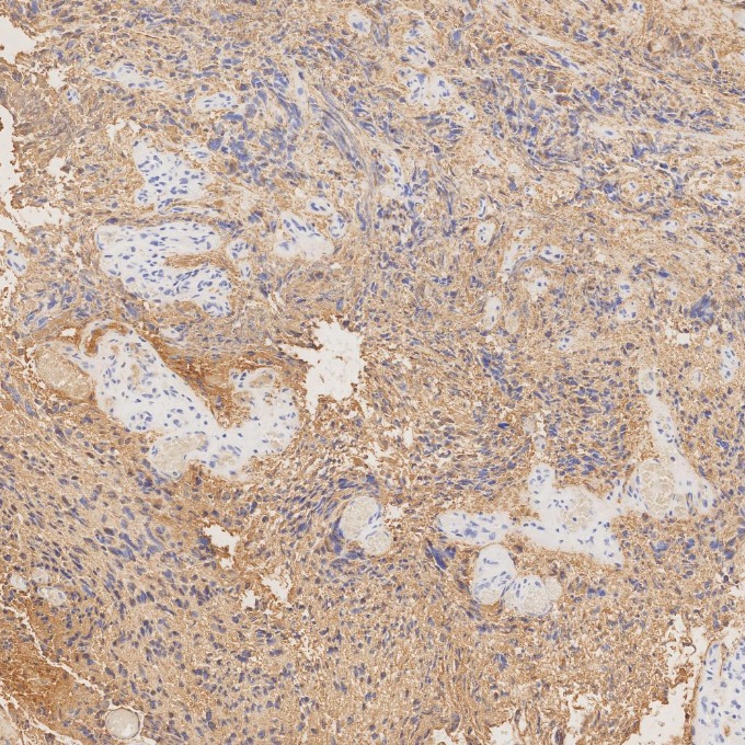 IHC staining of human gliomas using 81063-1-RR IHC staining of human gliomas using 81063-1-RR