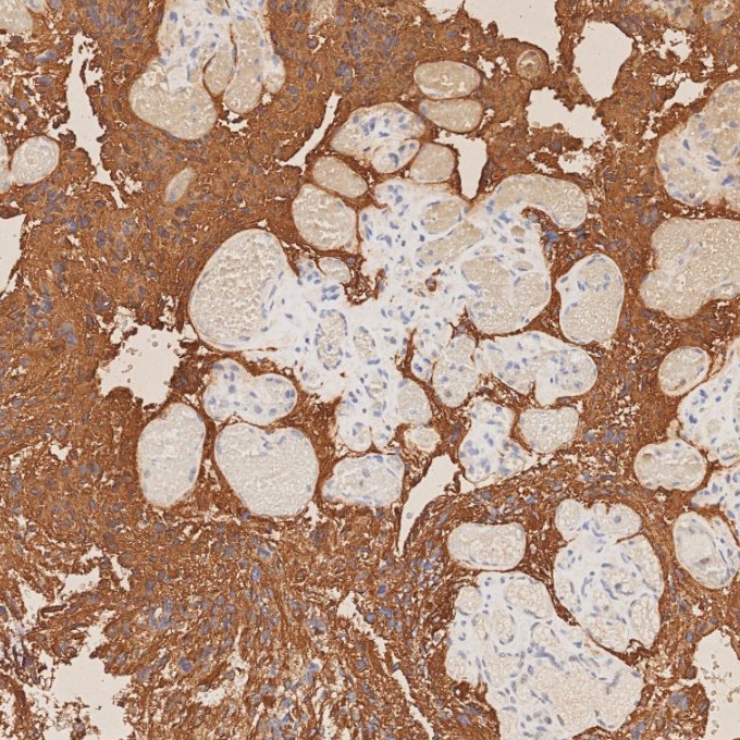 IHC staining of human gliomas using 81063-1-RR IHC staining of human gliomas using 81063-1-RR