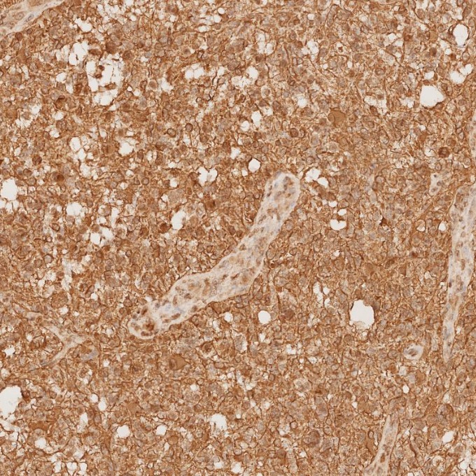 IHC staining of human gliomas using 81063-1-RR IHC staining of human gliomas using 81063-1-RR