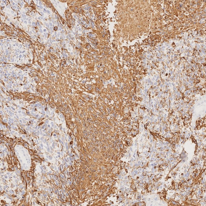 IHC staining of human gliomas using 81063-1-RR IHC staining of human gliomas using 81063-1-RR