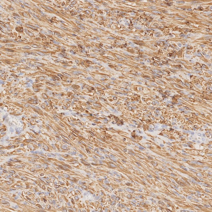IHC staining of human gliomas using 81063-1-RR IHC staining of human gliomas using 81063-1-RR