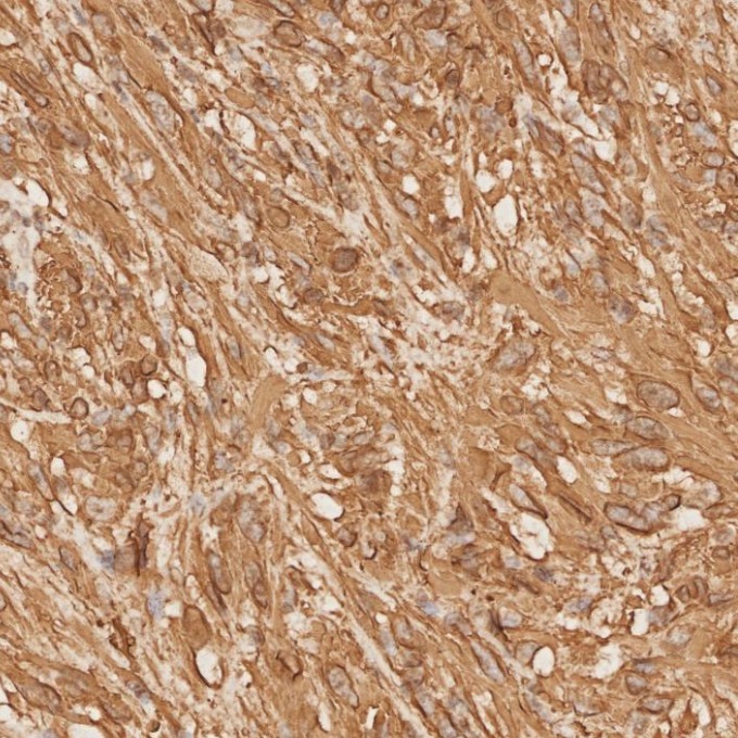 IHC staining of human gliomas using 81063-1-RR IHC staining of human gliomas using 81063-1-RR