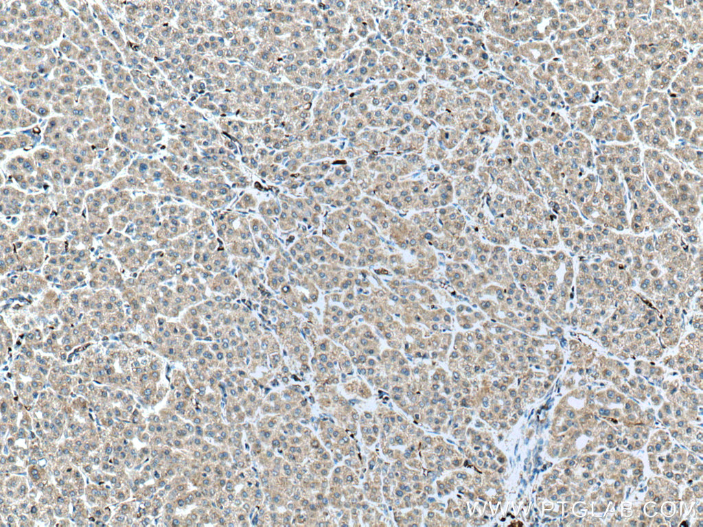 IHC staining of human liver cancer using 11293-1-AP (same clone as 11293-1-PBS)
