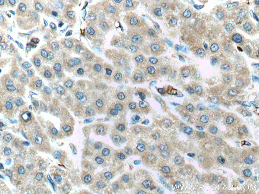 IHC staining of human liver cancer using 11293-1-AP (same clone as 11293-1-PBS)