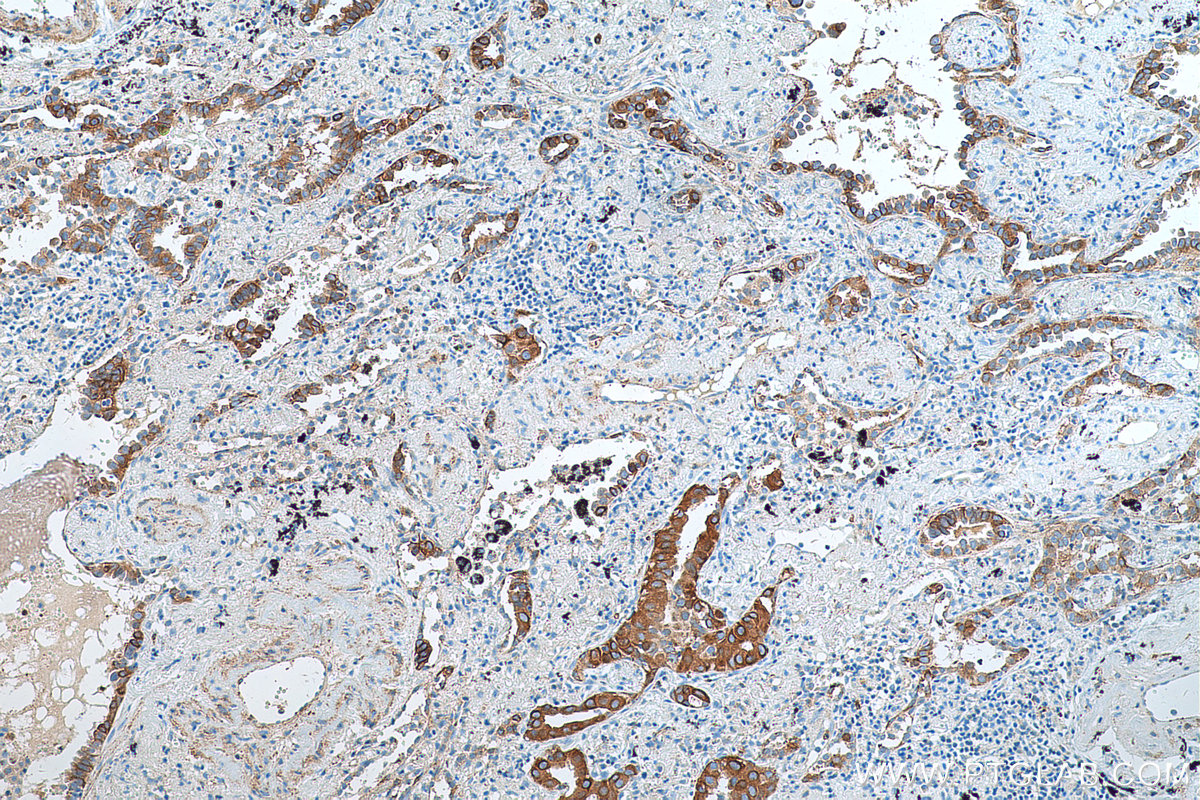 IHC staining of human lung cancer using 55038-1-AP (same clone as 55038-1-PBS)