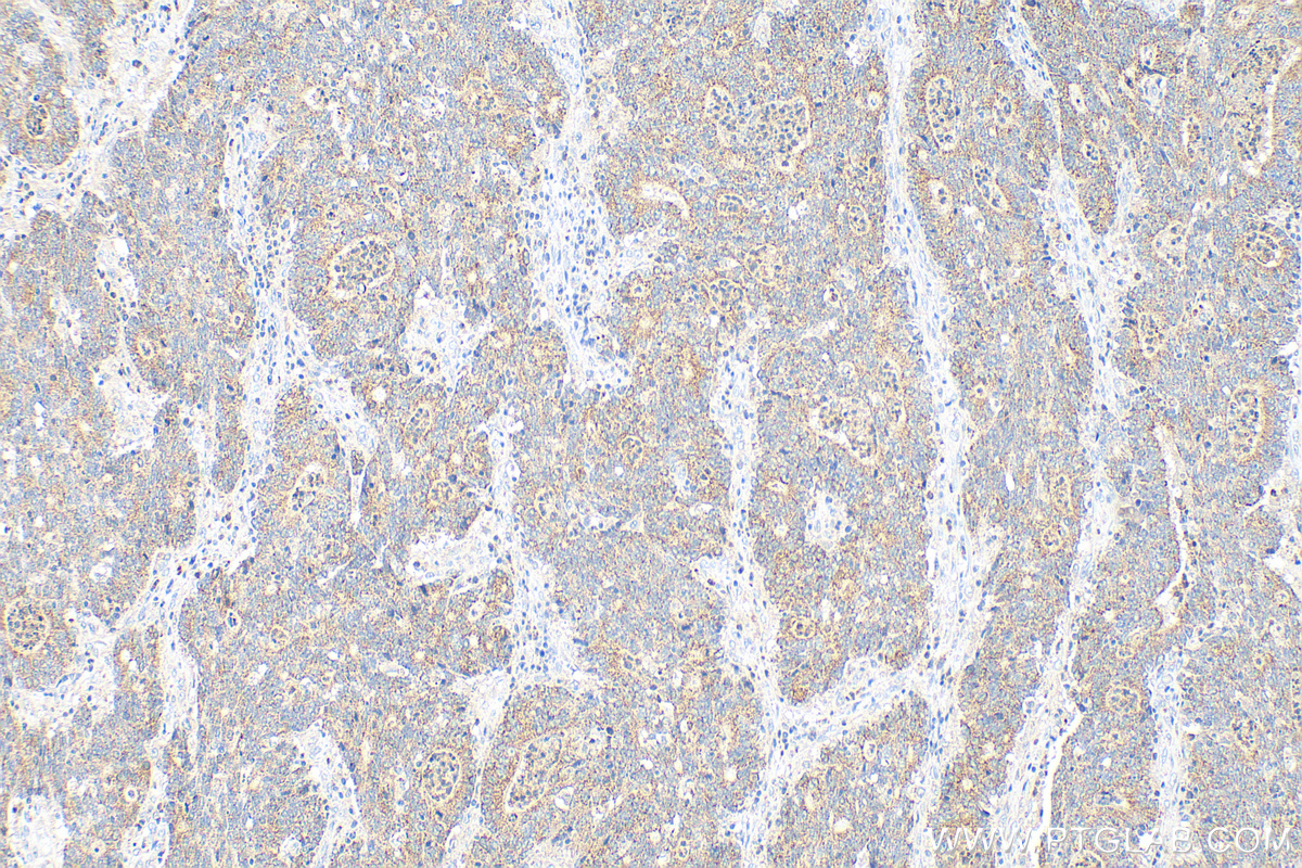IHC staining of human colon cancer using 10356-1-AP (same clone as 10356-1-PBS)