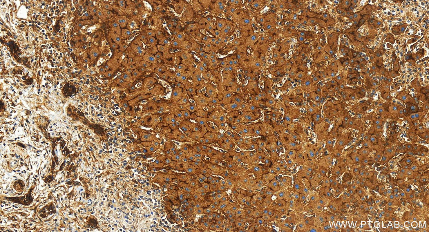 IHC staining of human intrahepatic cholangiocarcinoma using 83304-1-RR