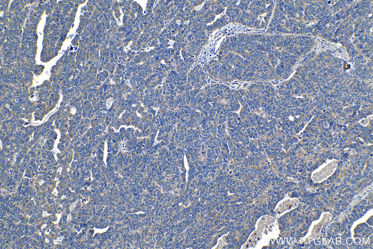 Immunohistochemical analysis of paraffin-embedded human ovary tumor tissue slide using 26123-1-AP (GHDC antibody) at dilution of 1:200 (under 10x lens). Heat mediated antigen retrieval with Tris-EDTA buffer (pH 9.0). IHC staining of human ovary tumor using 26123-1-AP