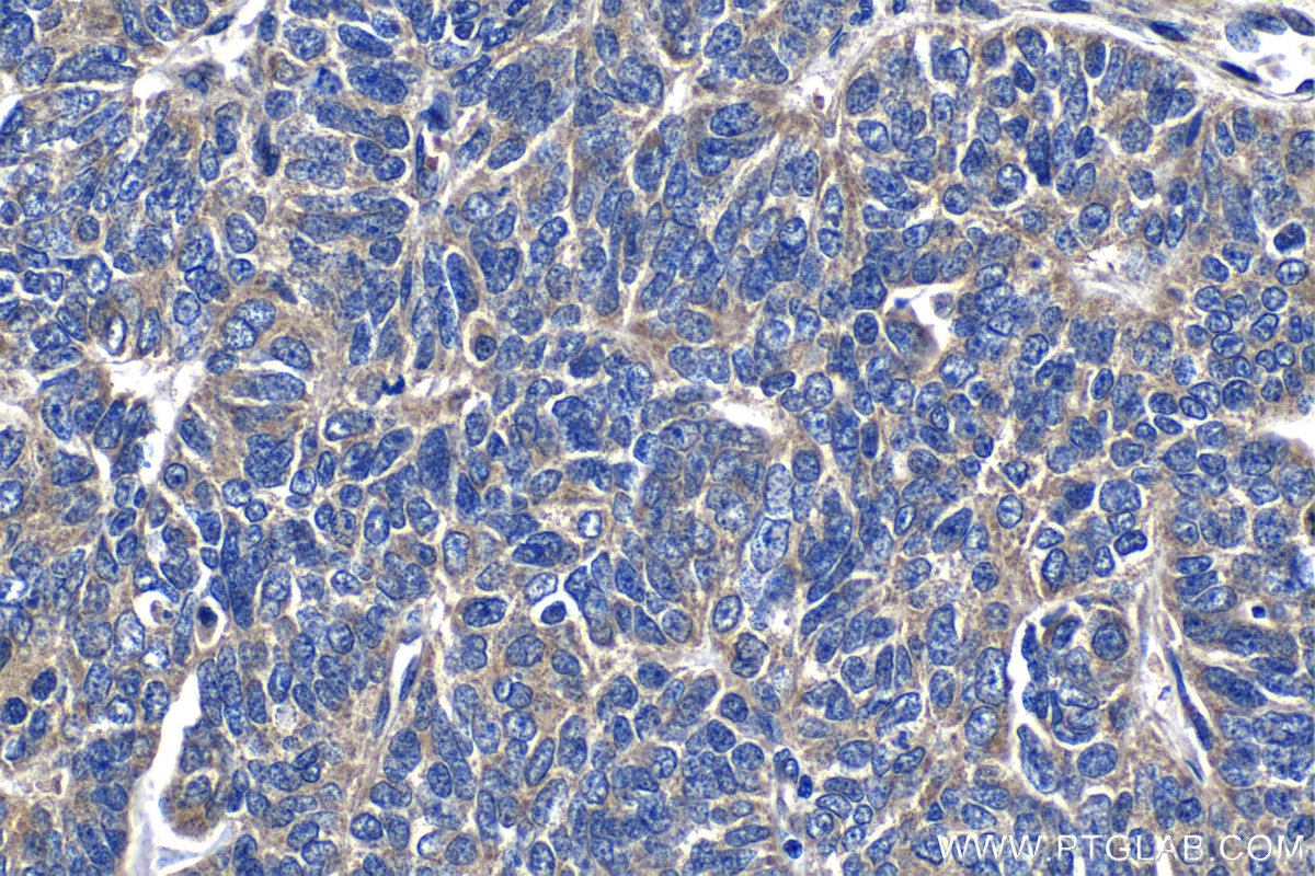 Immunohistochemical analysis of paraffin-embedded human ovary tumor tissue slide using 26123-1-AP (GHDC antibody) at dilution of 1:200 (under 40x lens). Heat mediated antigen retrieval with Tris-EDTA buffer (pH 9.0). IHC staining of human ovary tumor using 26123-1-AP
