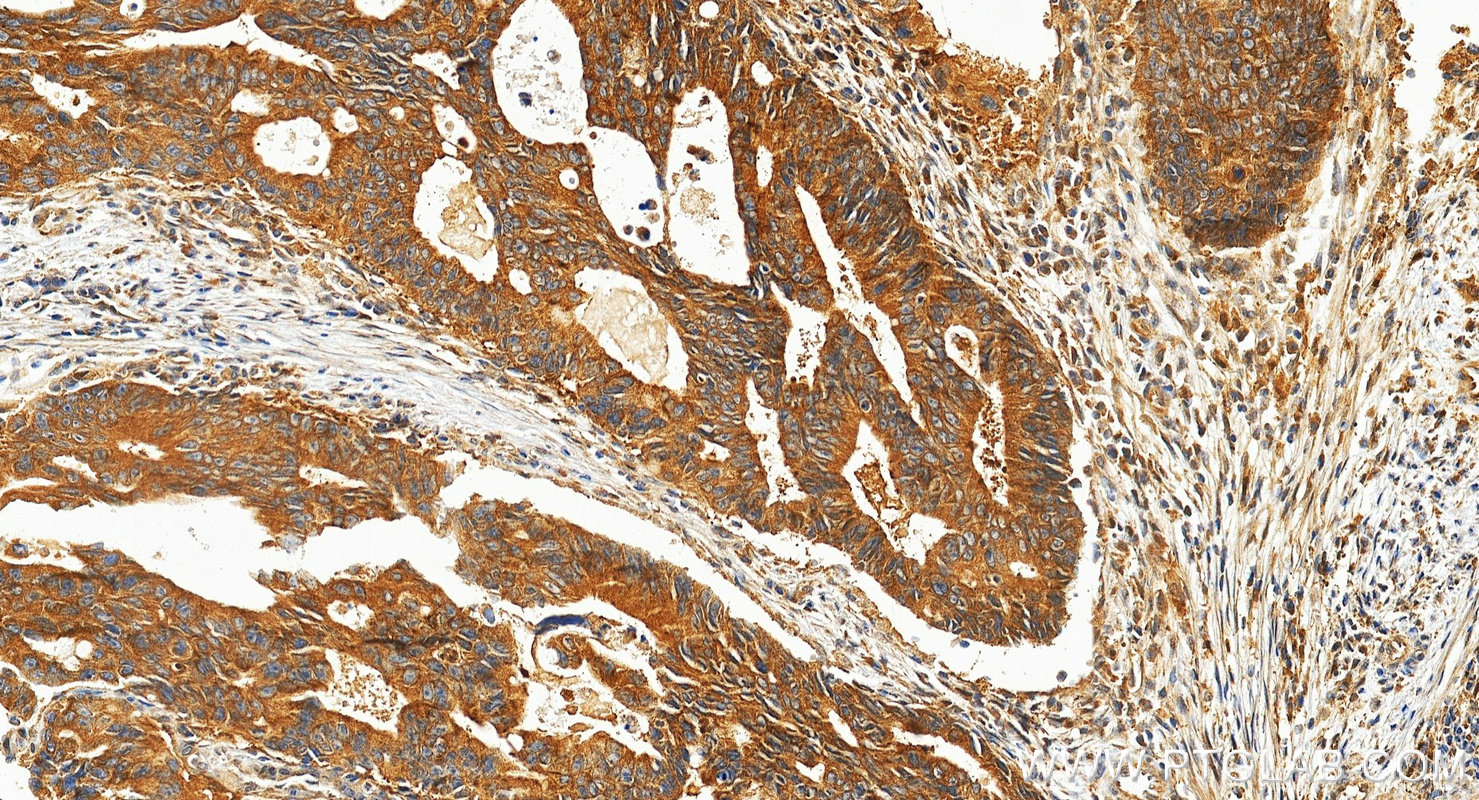 IHC staining of human colon cancer using 19896-1-AP (same clone as 19896-1-PBS) IHC staining of human colon cancer using 19896-1-AP (same clone as 19896-1-PBS)