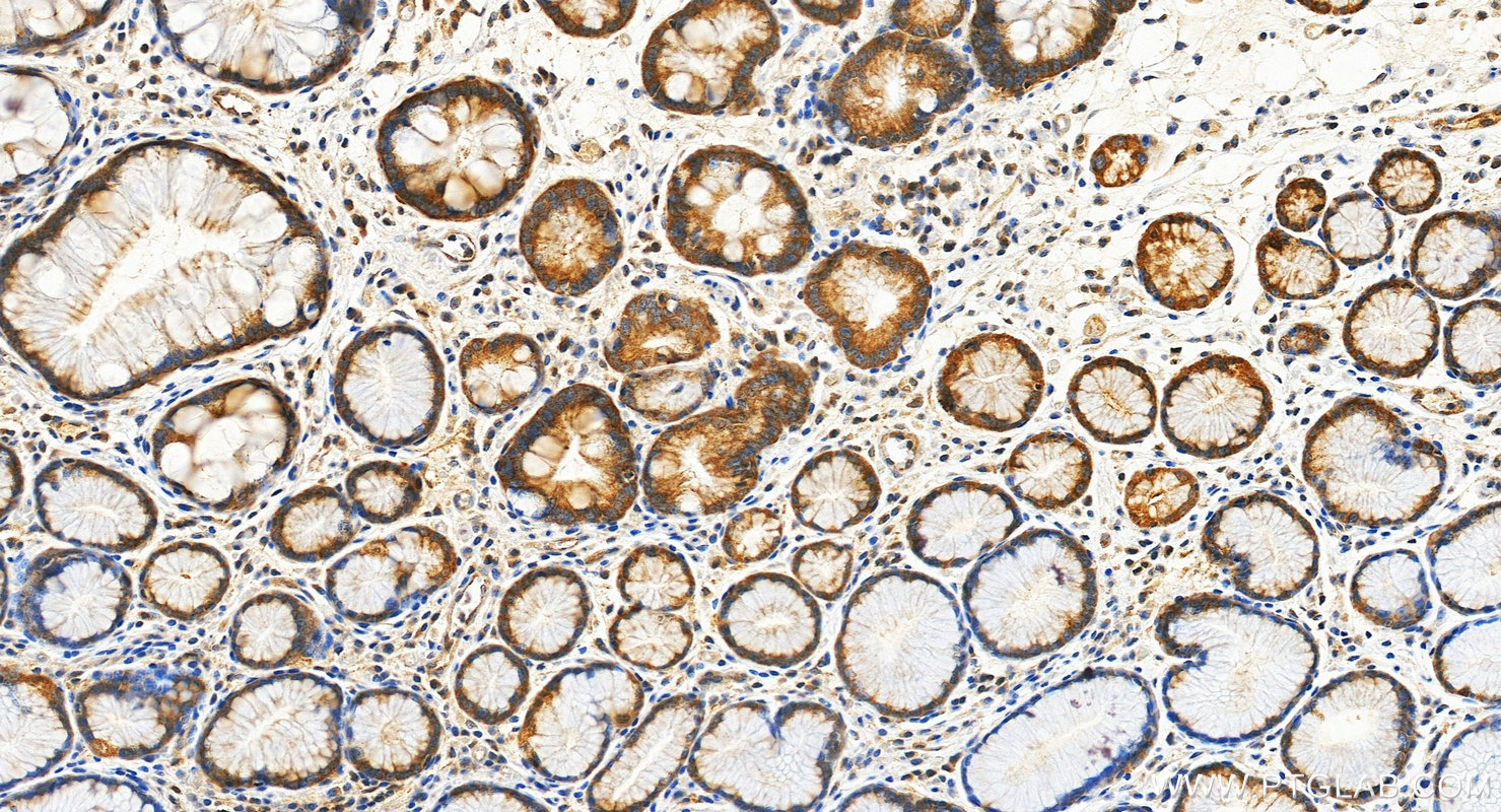 IHC staining of human stomach cancer using 19896-1-AP (same clone as 19896-1-PBS) IHC staining of human stomach cancer using 19896-1-AP (same clone as 19896-1-PBS)
